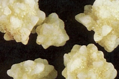 Kidneystone Analysis
